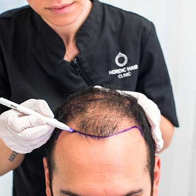 Nordic hair clinic hårlinje