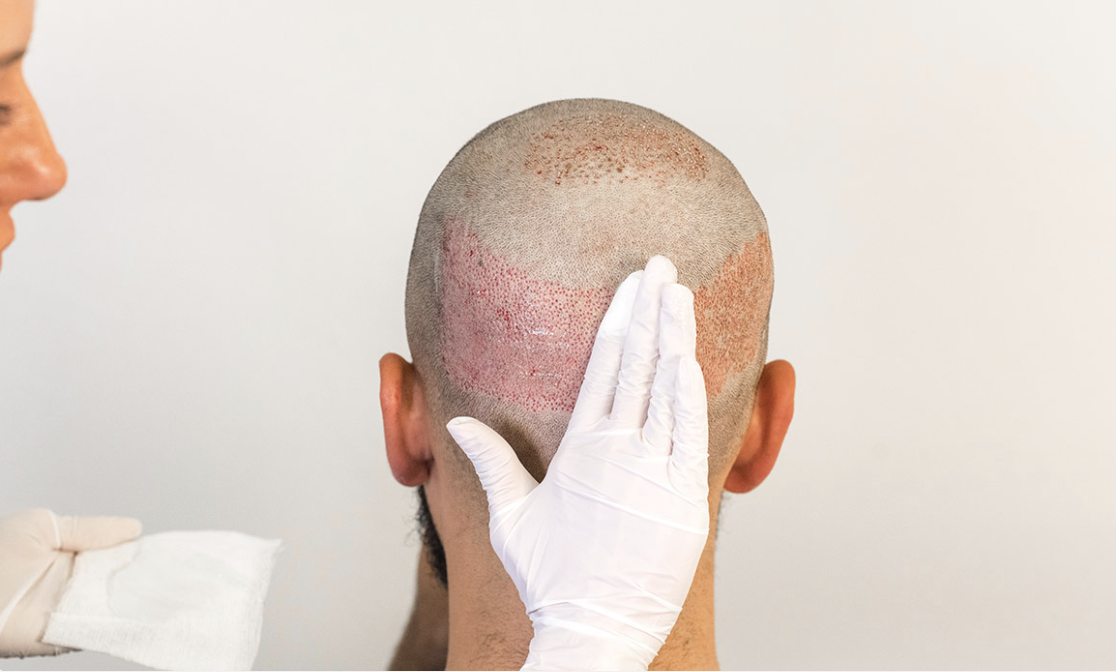 How to remove the bandage after a hair transplant? Nordic Hair