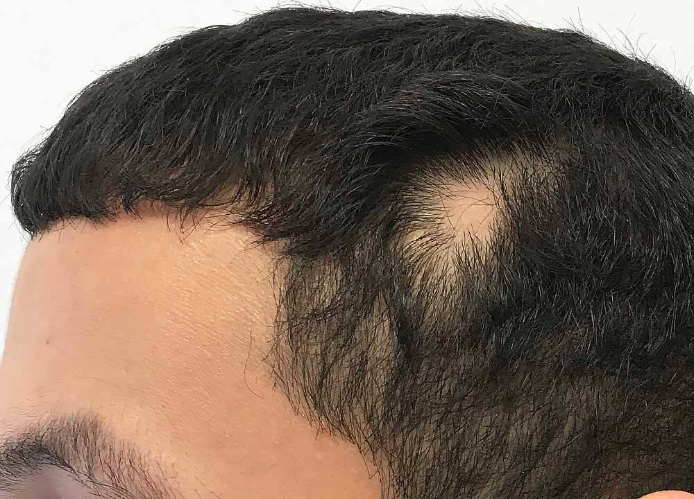 fläckvis håravfall hårtransplantasjoner