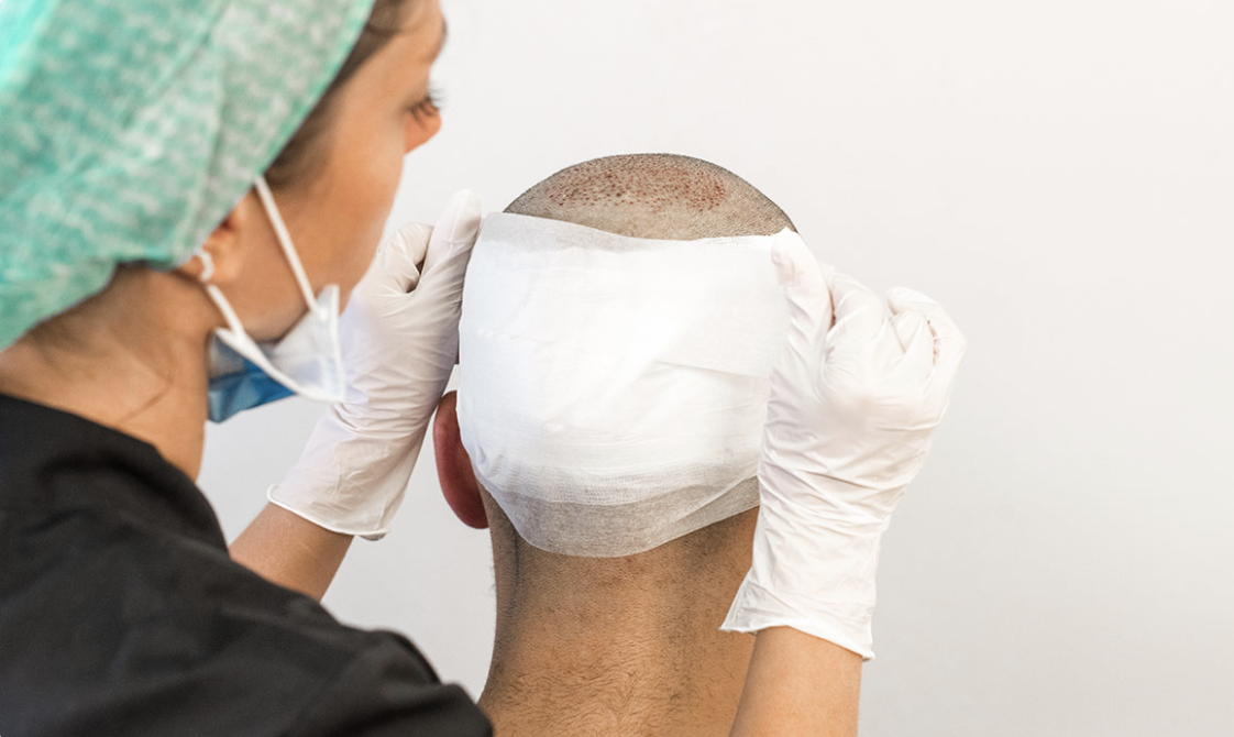 How to remove the bandage after a hair transplant? Nordic Hair