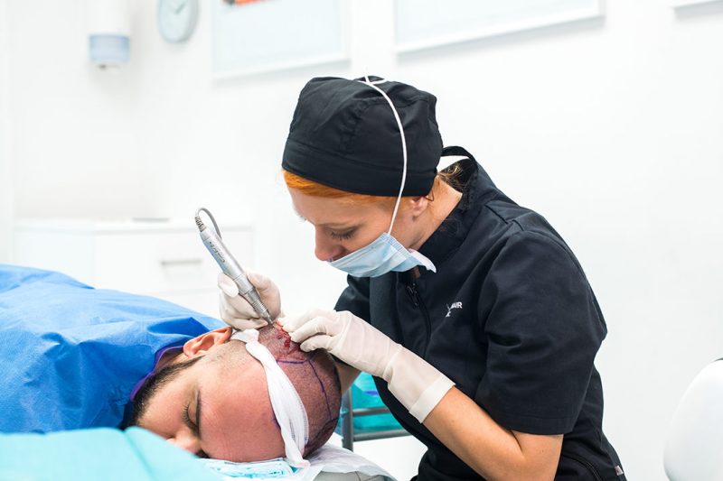 8 most frequently asked questions before a hair transplant – Nordic Hair
