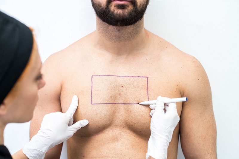 Body Hair Transplant - What happens when the hair on the back of your neck  is not enough?