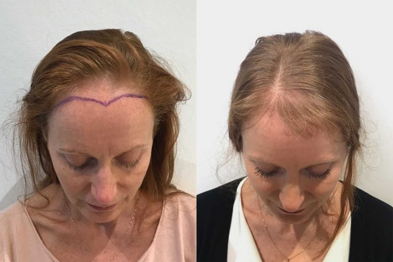 Hårtransplantation för kvinnor – Nordic Hair
