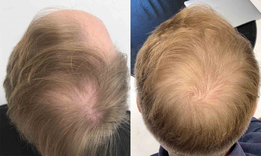 Nordic hair clinic resultat