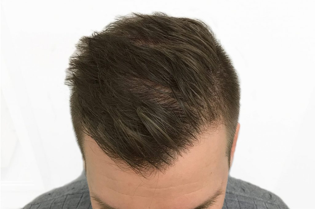 nordic hair clinic resultat