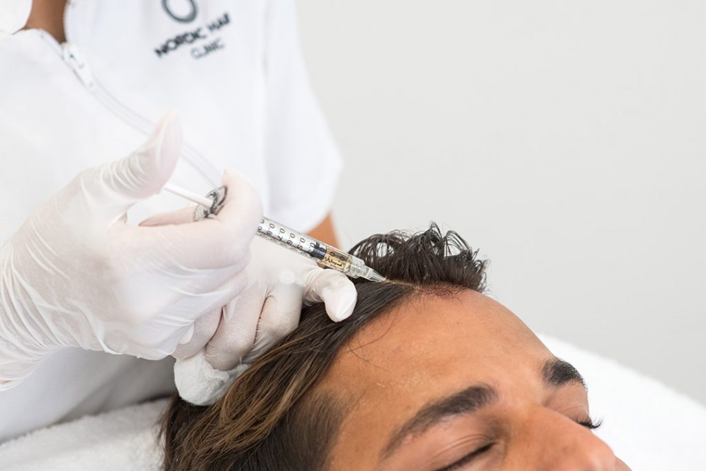 Sjuksköterska injicerar blodplasma med tillväxtfaktorer ytligt i skalpen för att stimulera hårväxt