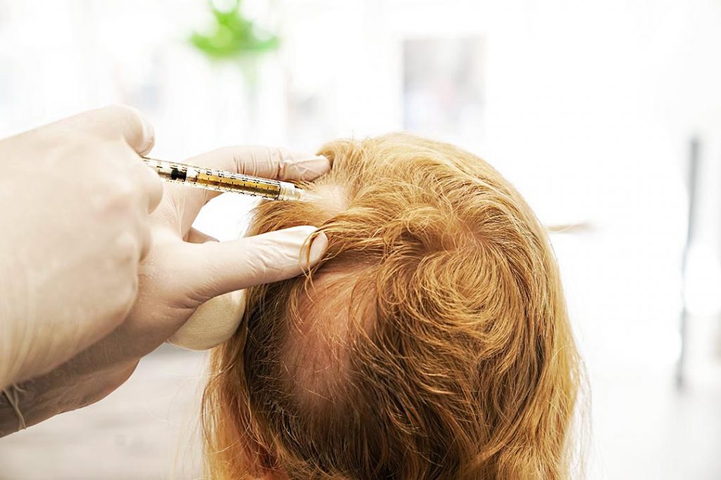 kvinna med alopecia areata gör prp-behandling