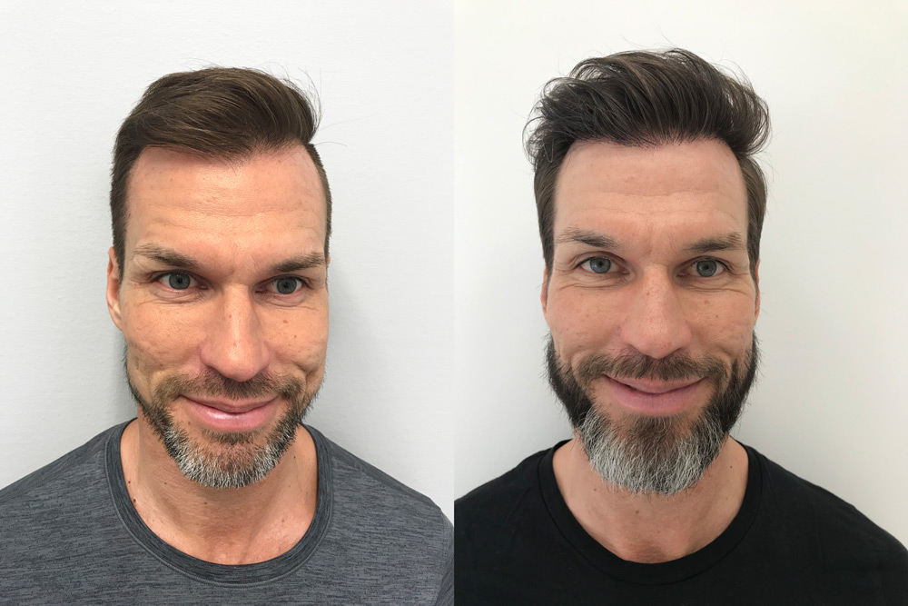 Hair transplant - Get your hair back with a safe method – Nordic Hair
