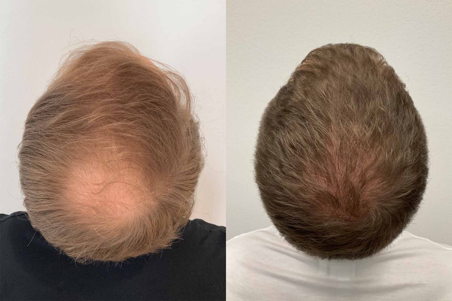 Resultat före och efter en hårtransplantation – Nordic Hair