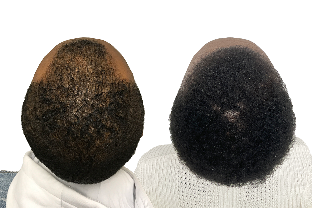 resultat efter en manlig hårtransplantation