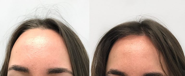 Hårtransplantation för kvinnor – Nordic Hair