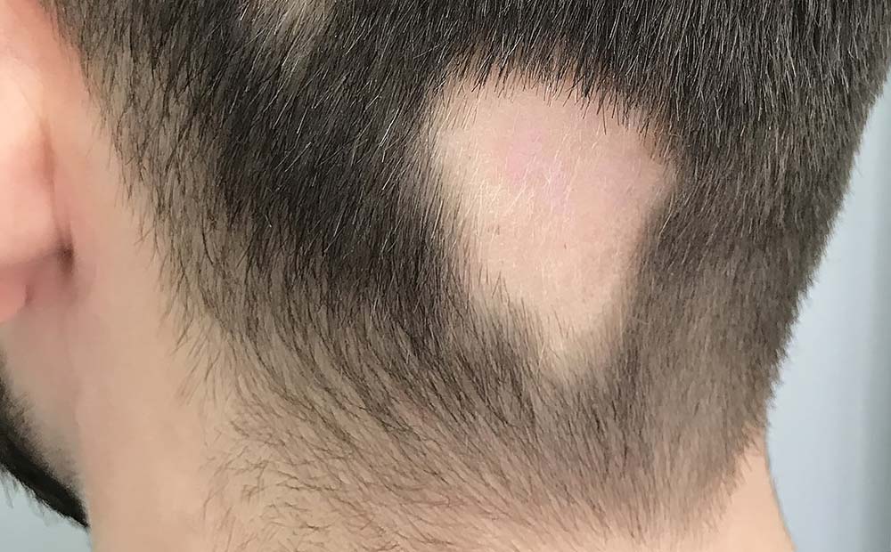 Alopecia Areata Causes Symptoms and Diagnosis
