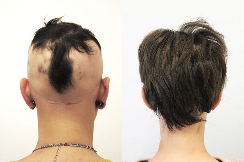 alopecia totalis behandling