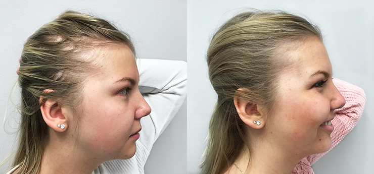 hårtransplantation resultat