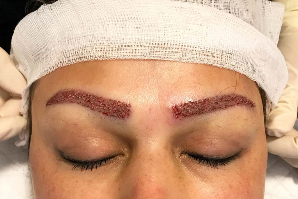 kvinna efter en ögonbrynstransplantation