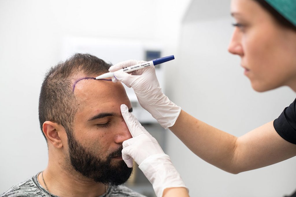 Hair transplantation for men – Nordic Hair