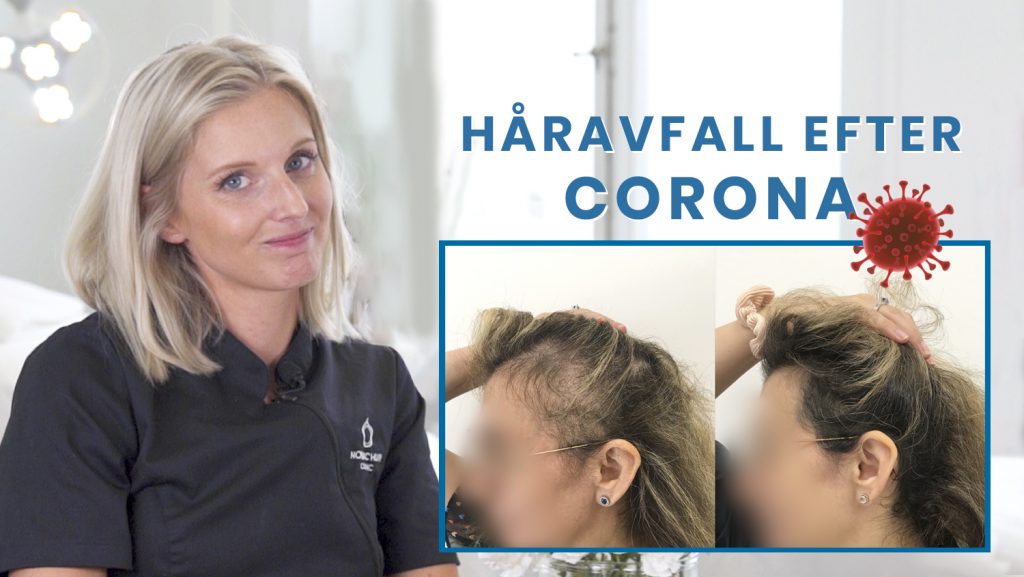 corona covid-19 håravfall