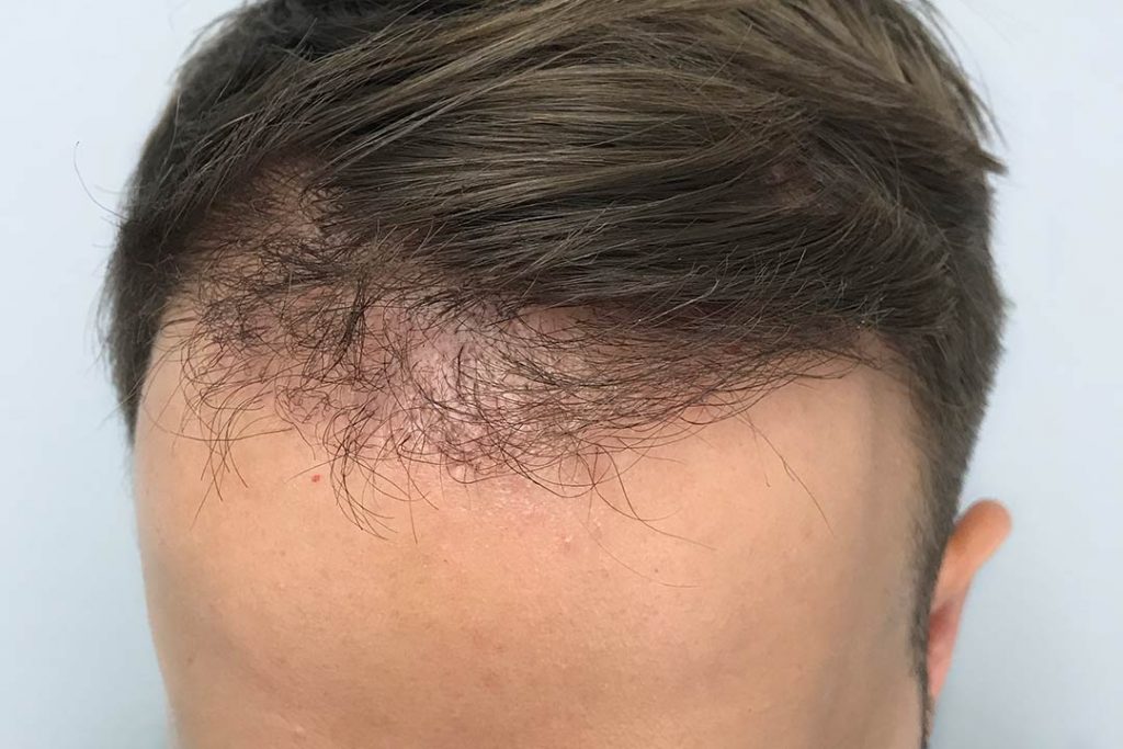 When does hair start to grow after a hair transplant? – Nordic Hair