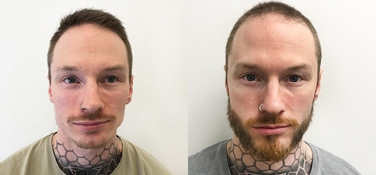 PRP and hair transplantation before and after pictures – Nordic Hair - 3 /  14