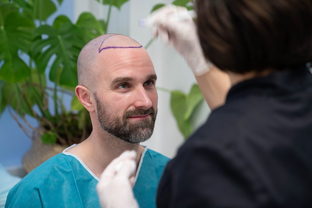 you get the area mapped out before your hair transplant, hair transplant sweden