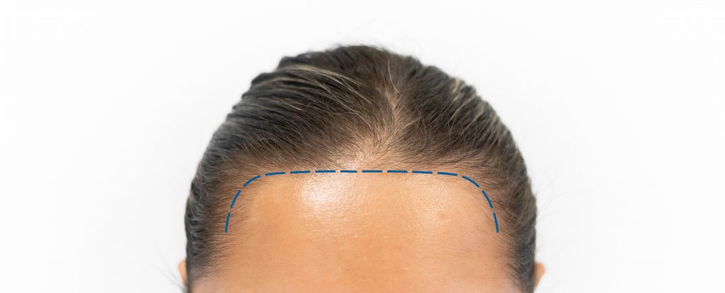 En hårgrænse justeres foran hårtransplantation for kvinder