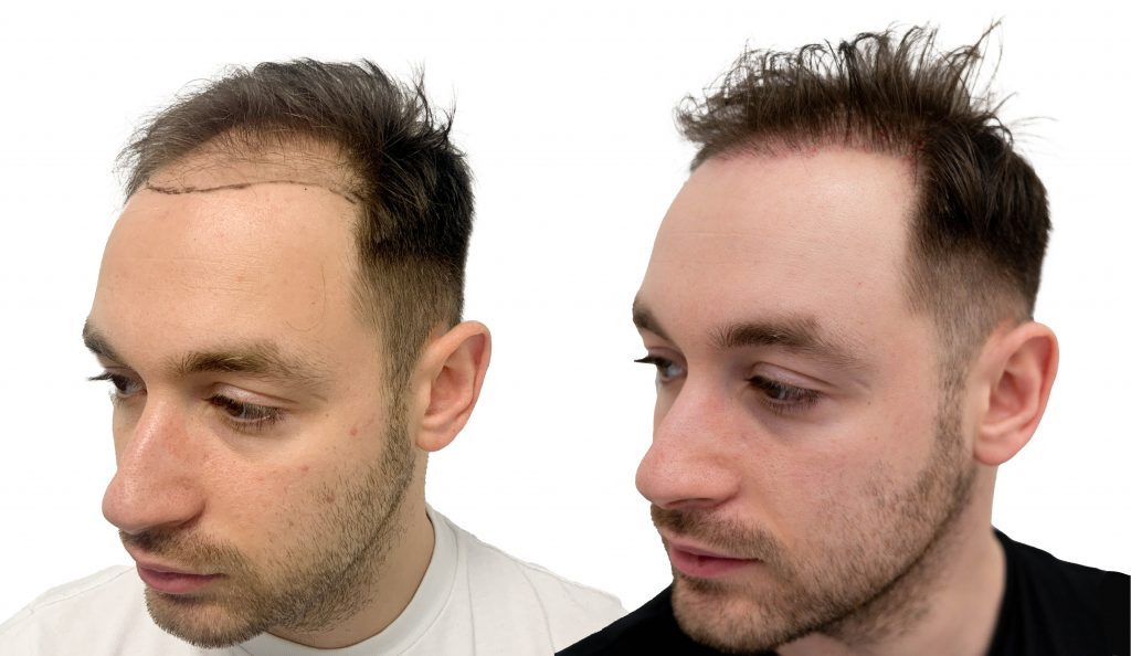 Crown Area Hair Transplant - Vertex Operation and Costs in 2023