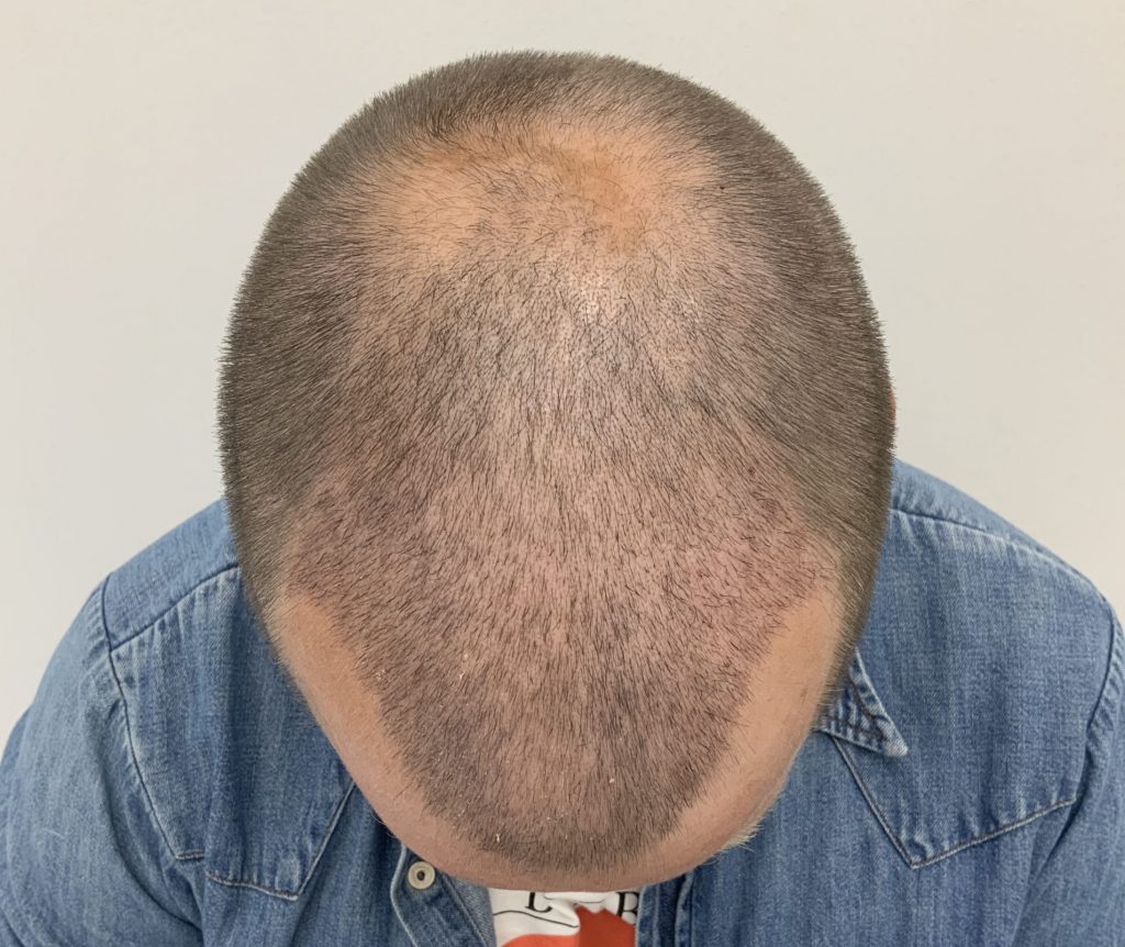 How does the hair grow after a hair transplant? – Nordic Hair