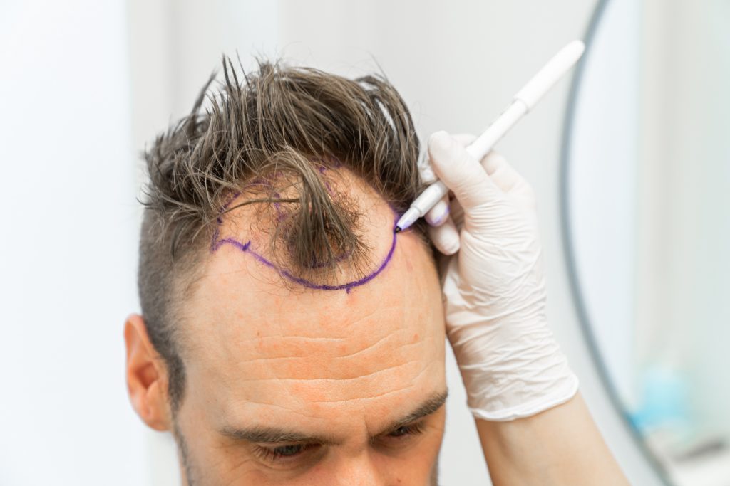 How does the hair grow after a hair transplant? – Nordic Hair