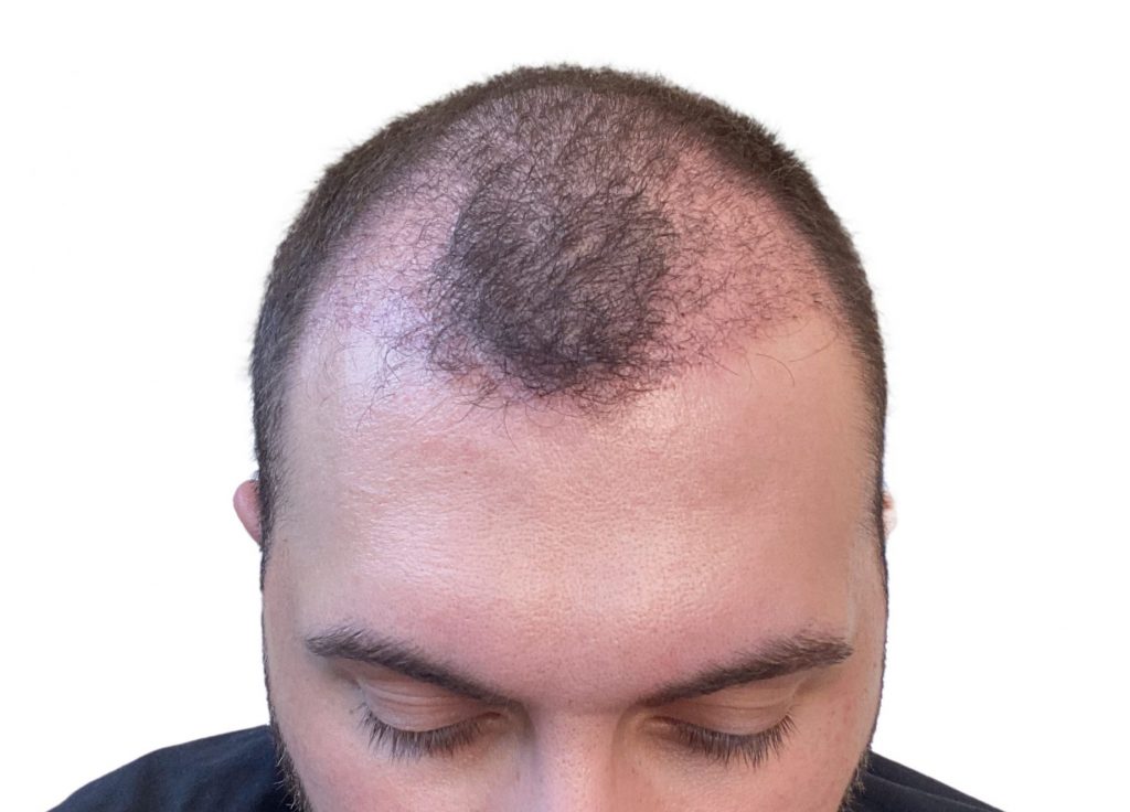 Record breaking hair transplant surgery – 6 months have passed!