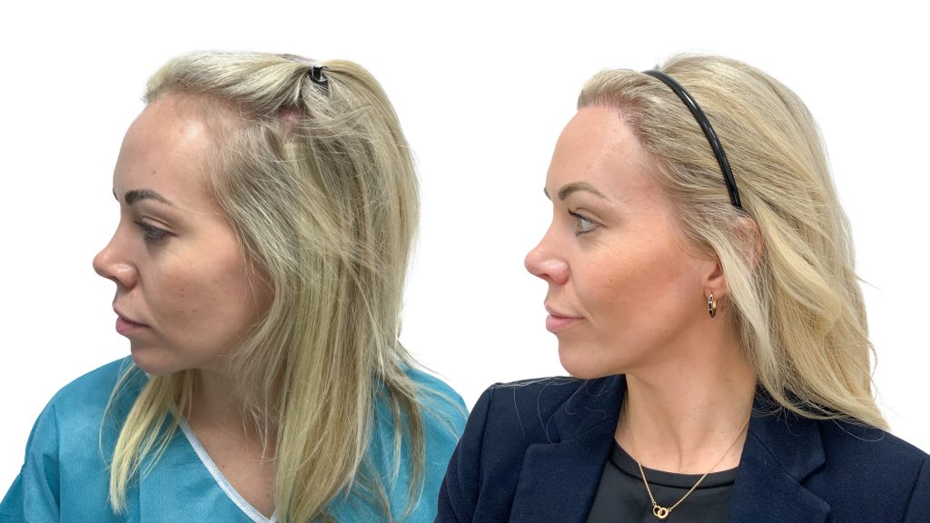 Karin Säreviks resultat efter en hårtransplantation på Nordic Hair Clinic