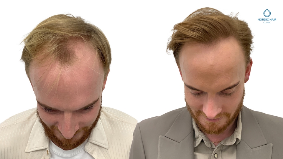 Simon 14 months after his hair transplant