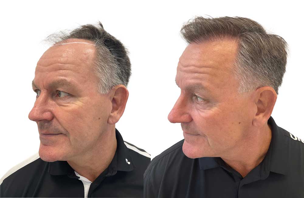 Rene efter hans hårtransplantation