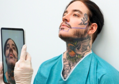 en man får en skäggtransplantation