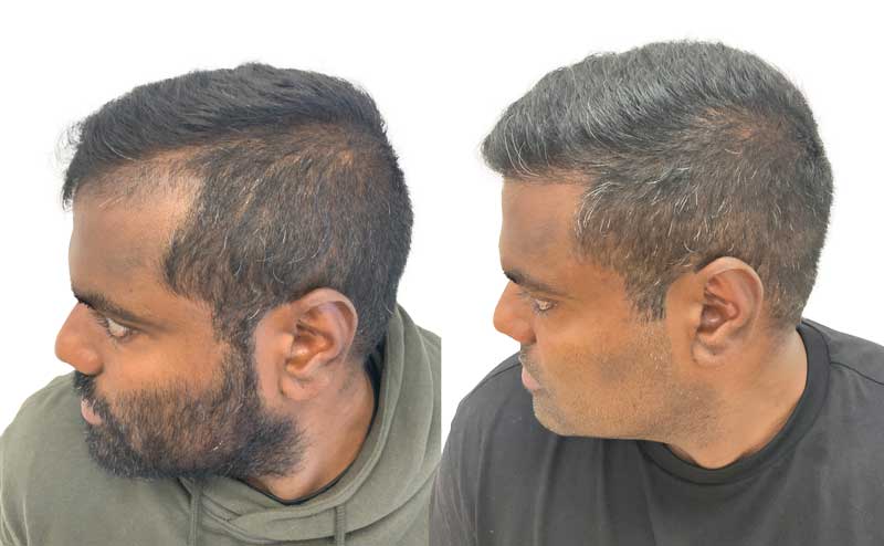 revendra före och efter sin hårtransplantation